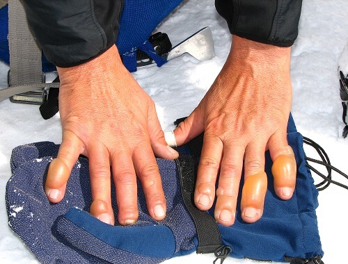 Chilblains are serious frostbite